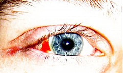 Заболявания, които можем да познаем по очите - 1