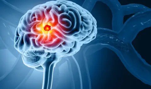 Лекар изброи 8-те най-чести причини за тумор на мозъка - 1