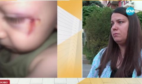 2-годишно дете е с шевове на лицето след инцидент в детски център - 1
