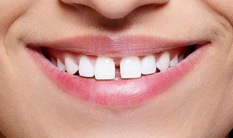 Три решения за премахване на разстоянието между зъбите - 1