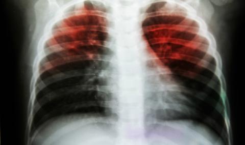 Първи смъртен случай от туберкулоза в Бургас - 1