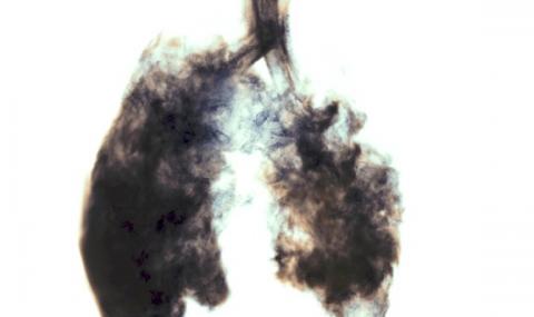 Първи сме и по белодробни болести - 1