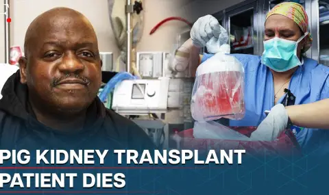 Издъхна пациентът с първия трансплантиран свински бъбрек ВИДЕО