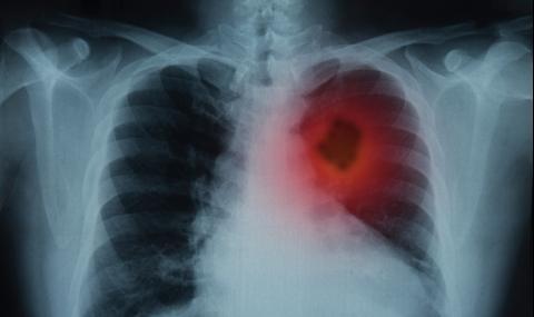 Посочиха основен симптом за появата на рак на белите дробове - 1