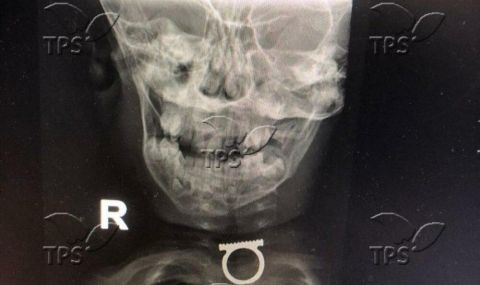 Лекарите в Израел извадиха пръстен от гърлото на двегодишно момче - 1