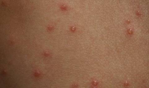 Варицела - най-разпространената неконтролируема болест у нас - 1