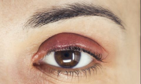 Бабини лекове срещу ечемик на окото - 1