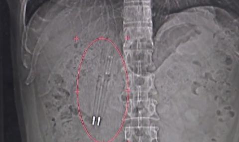 Китаец живя 36 години с химикалки в корема - 1