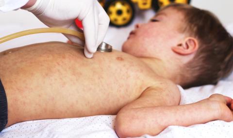 Задължителна ваксина срещу морбили в Германия - 1