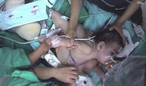 Разделиха тримесечни сиамски близнаци в Шанхай - 1
