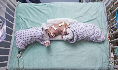 Разделиха сиамски близнаци с общи череп и кръвоносна система - 1