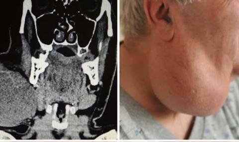 Във ВМА отстраниха огромен тумор от шията на мъж - 1