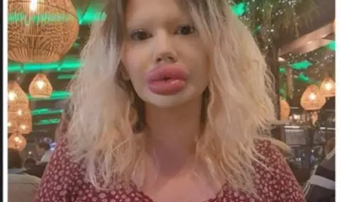 Българското Барби: Може да ослепея от хиалурона, но няма да спра! - 1