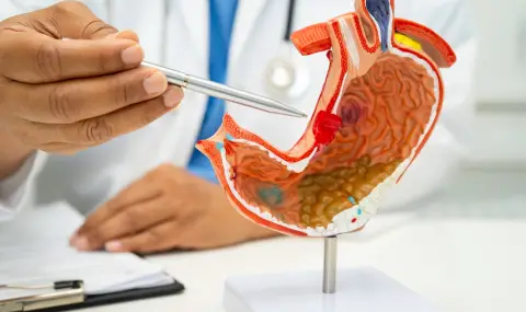 Учени откриха главните причинители на рак на стомаха  - 1