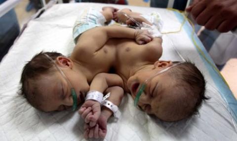 Ромката, родила сиамски близнаци от братовчед си, чака държавата да ги раздели - 1
