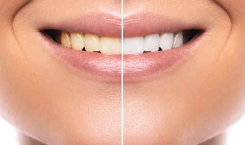 На какво се дължи пожълтяването на зъбите и как да го спрем? - 1