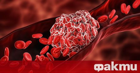 Тромбозата е патологично съсирване на кръвта в кръвоносните съдове Причините