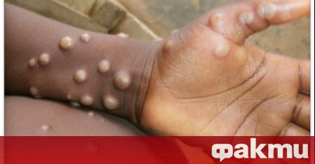 Португалските здравни власти потвърдиха пет случая на маймунска шарка при