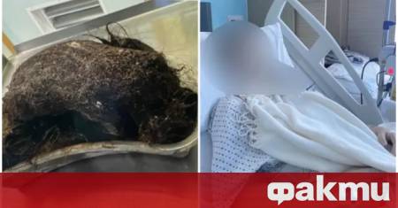 Топка косми е извадена от стомаха на 14 годишно момиче във