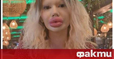 Неправилно поставяне на хиалурон в лицето може да доведе до