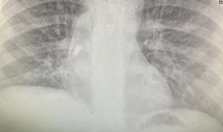 Спасиха дете, след като млечен зъб заседна в трахеята му