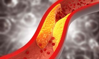 Симптомите, по които да разпознаем високия холестерол 