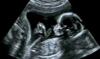 Генетична мистерия e причината за 1/2 от всички нарушения в развитието на плода