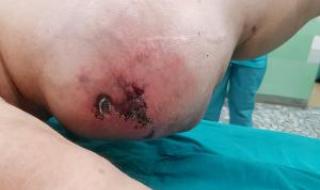 Във ВМА отстраниха 6-килограмов тумор от бедрото на пациент