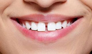 Три решения за премахване на разстоянието между зъбите