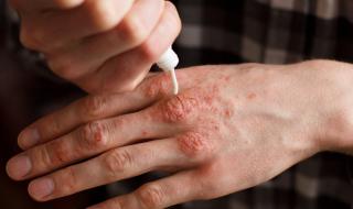 Как да преборим псориазиса без лекарства
