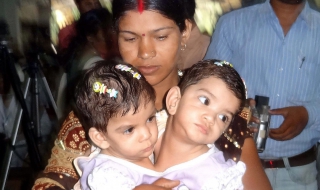 Разделиха сиамски близнаци в Индия