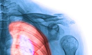 Три външни признака за тумор в белите дробове