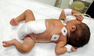Успешно оперираха шесткракото бебе в Пакистан