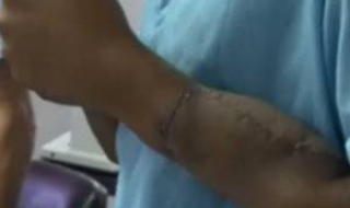 Присадиха нови ръце на индиец