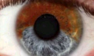 Лазер сменя цвета на очите