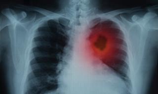 Посочиха основен симптом за появата на рак на белите дробове