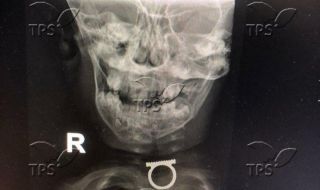 Лекарите в Израел извадиха пръстен от гърлото на двегодишно момче