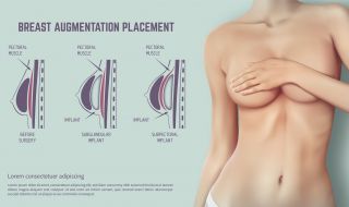 Ето кои жени не трябва да си слагат силикон според руски мамолог