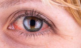 Kръвоизлив в окото може да е симптом на...