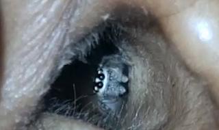 Стряскащо видео показа жив паяк да изпълзява от ухото на жена (ВИДЕО)
