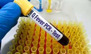 Първи случай на ку-треска в Пловдив