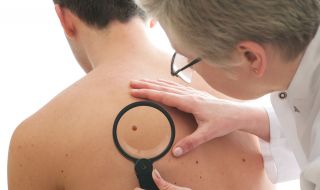 Как да разпознаем рака на кожата навреме? 