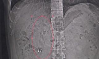 Китаец живя 36 години с химикалки в корема