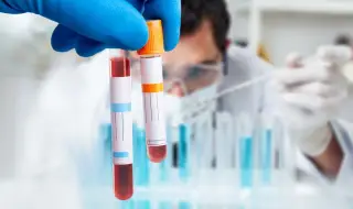 Нов кръвен тест има потенциала да открива над 50 вида рак в ранен стадий