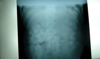 Вадят с клизма капсули с кокаин