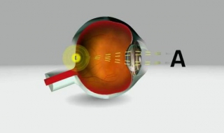 Мъж прогледна с дигитално око