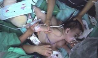 Разделиха тримесечни сиамски близнаци в Шанхай
