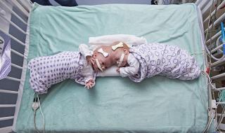 Разделиха сиамски близнаци с общи череп и кръвоносна система