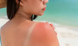 Как да се справим със слънчевото изгаряне