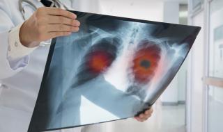 В София стартира проект за ранна диагностика на рак на белите дробове